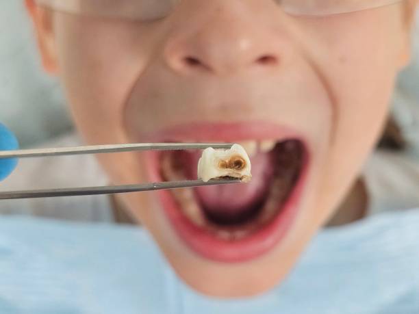 Best Emergency Dental Care for Broken or Chipped Teeth in Hawaiian Ocean View, HI